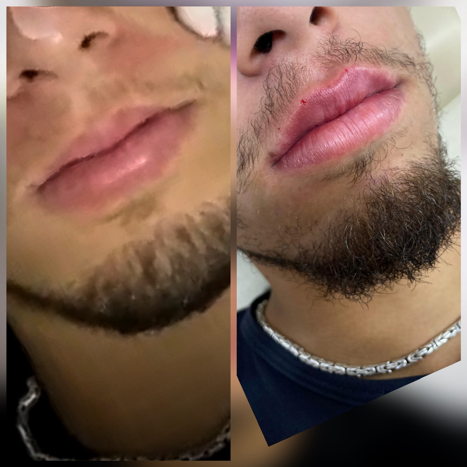 Preenchimento Labial - Antes e Depois